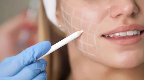 A imagem mostra uma mulher recebendo um procedimento estético, no qual um profissional utiliza um lápis branco para marcar o rosto dela. As marcas formam uma grade no lado direito da face, provavelmente para delinear ou planejar a aplicação de um tratamento, como um preenchimento ou contorno facial. A mulher usa uma faixa na cabeça e parece estar em um ambiente clínico, com o foco nas marcas feitas com o lápis e na ação cuidadosa do profissional.